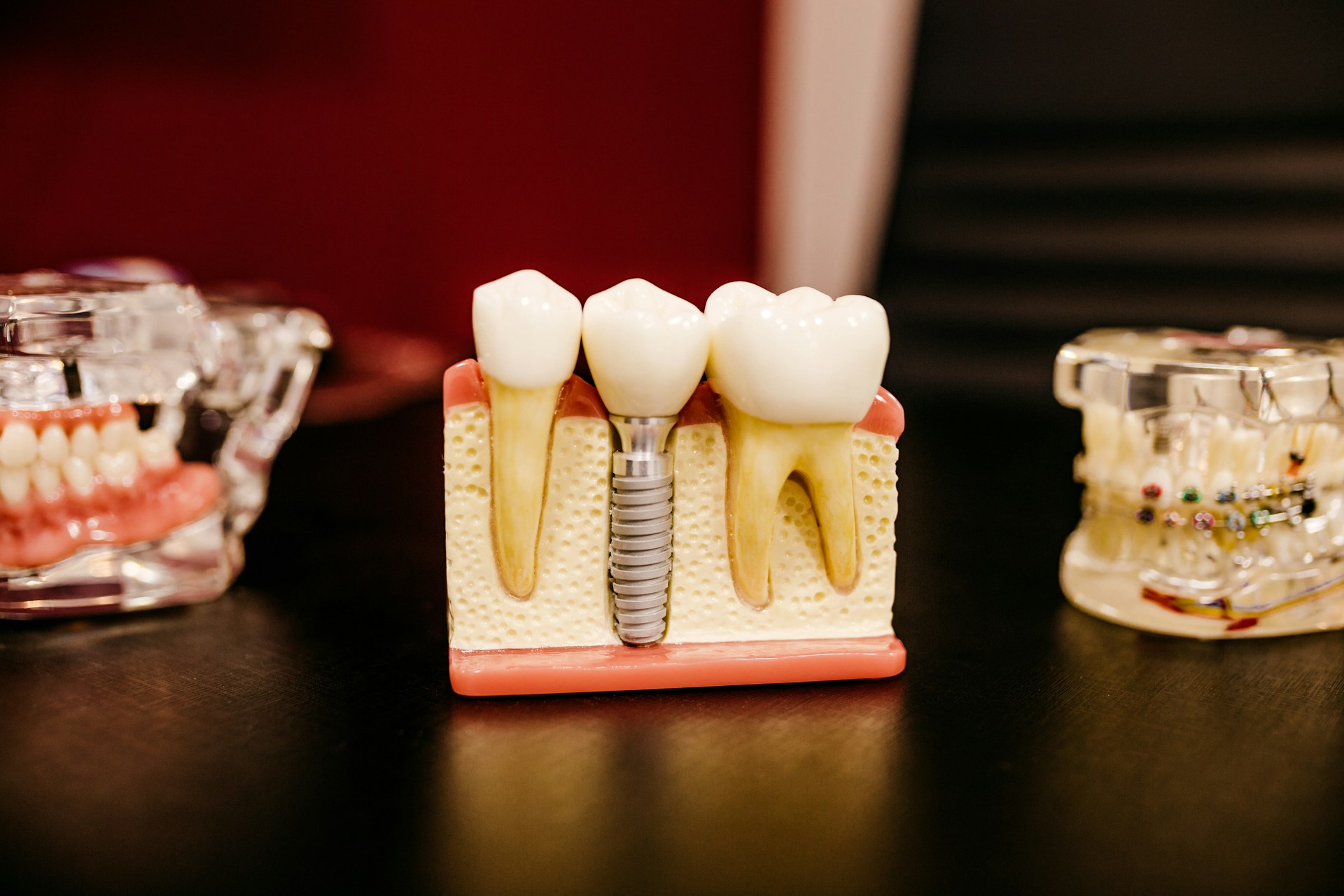 dental implant post in a piece of a mouth model