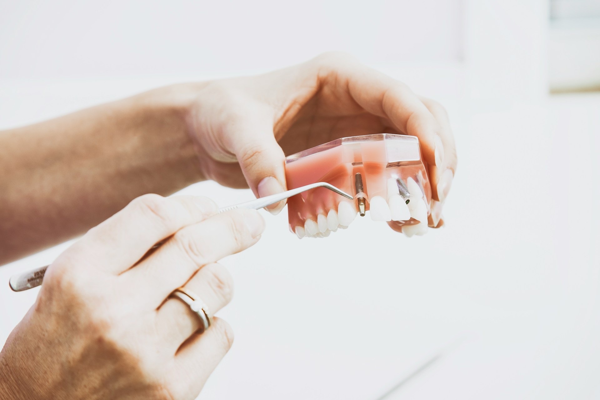 handing holding mouth model and pointing to dental implant