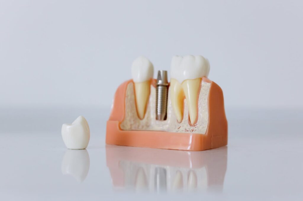model of dental implant in gums with unattached crown sitting next to it